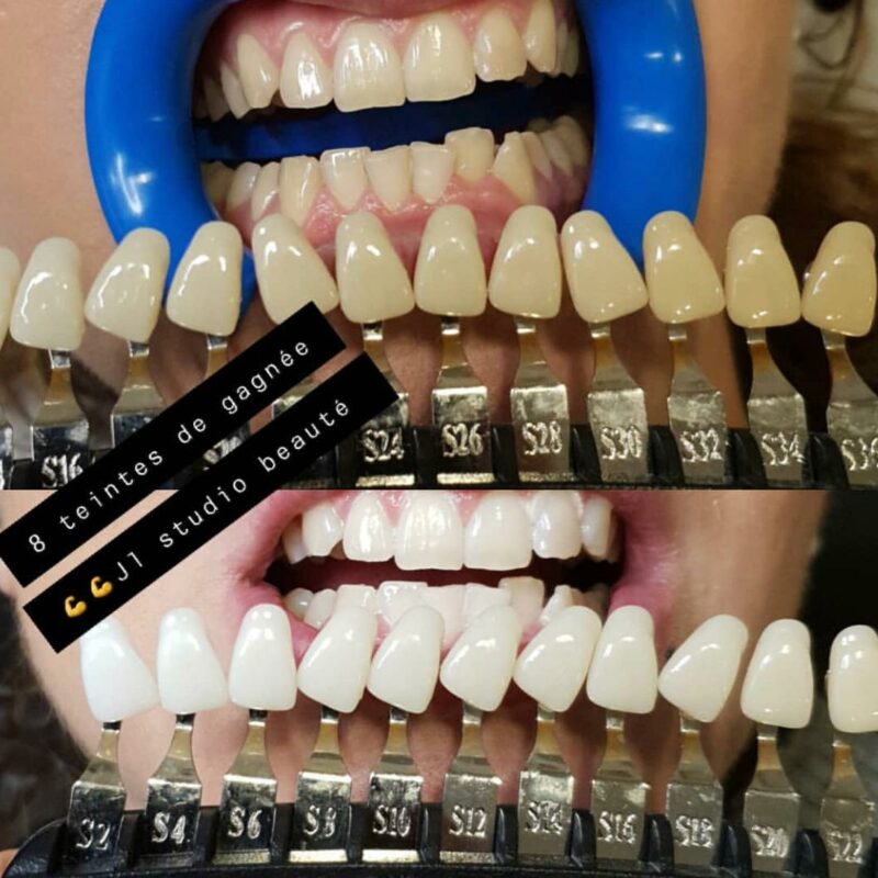 Éclaircissement dentaire  américain