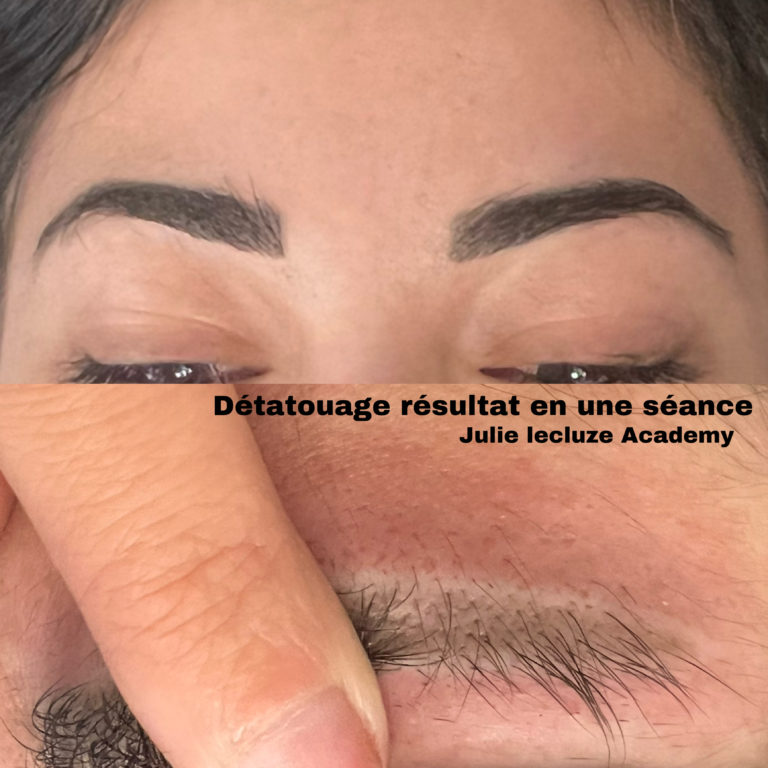 Le détatouage chez Lecluze Julie Institut & academy